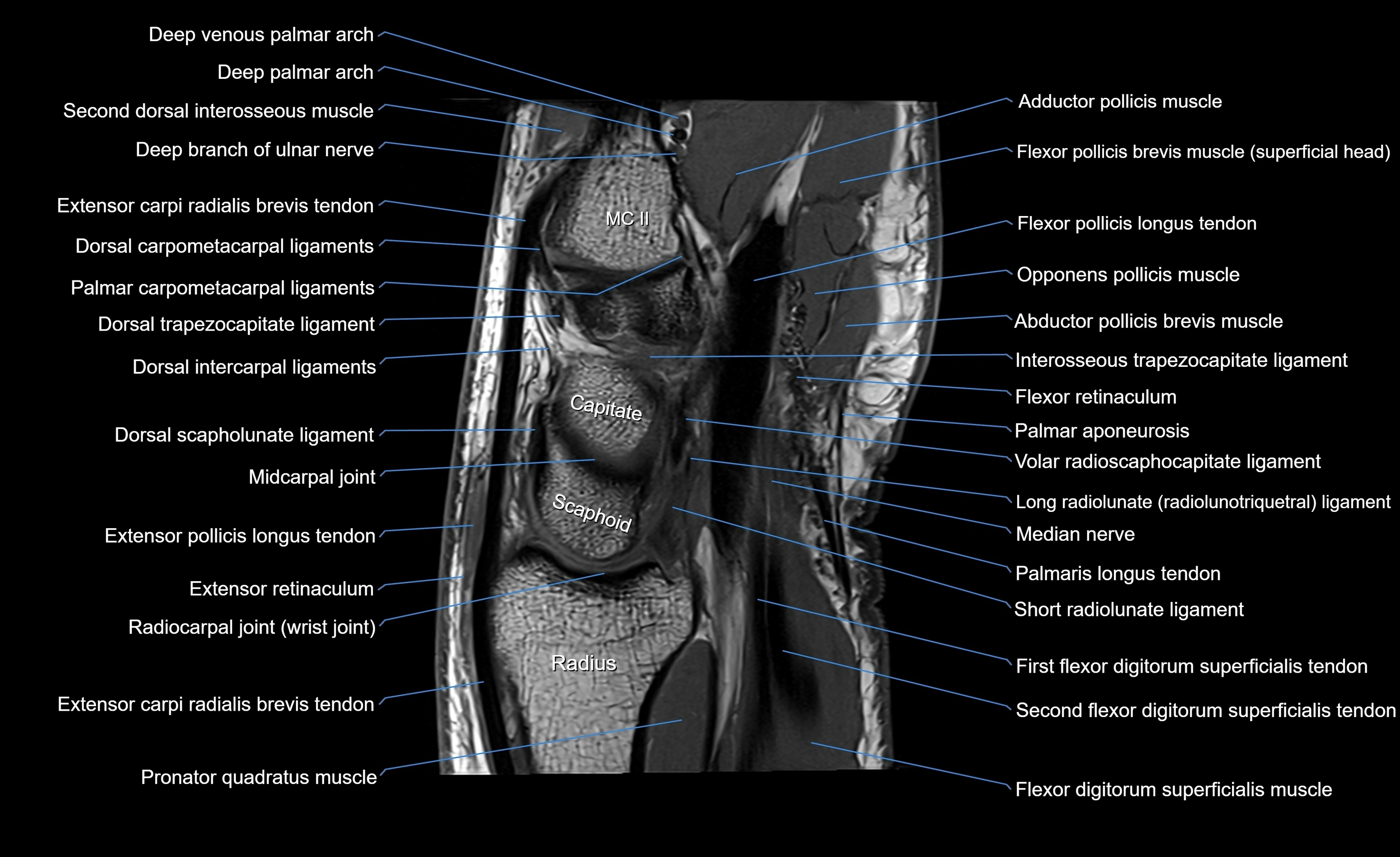 MRI wrist sagittal cross sectional anatomy 3T  radiology  image-img-00001-00010.webp